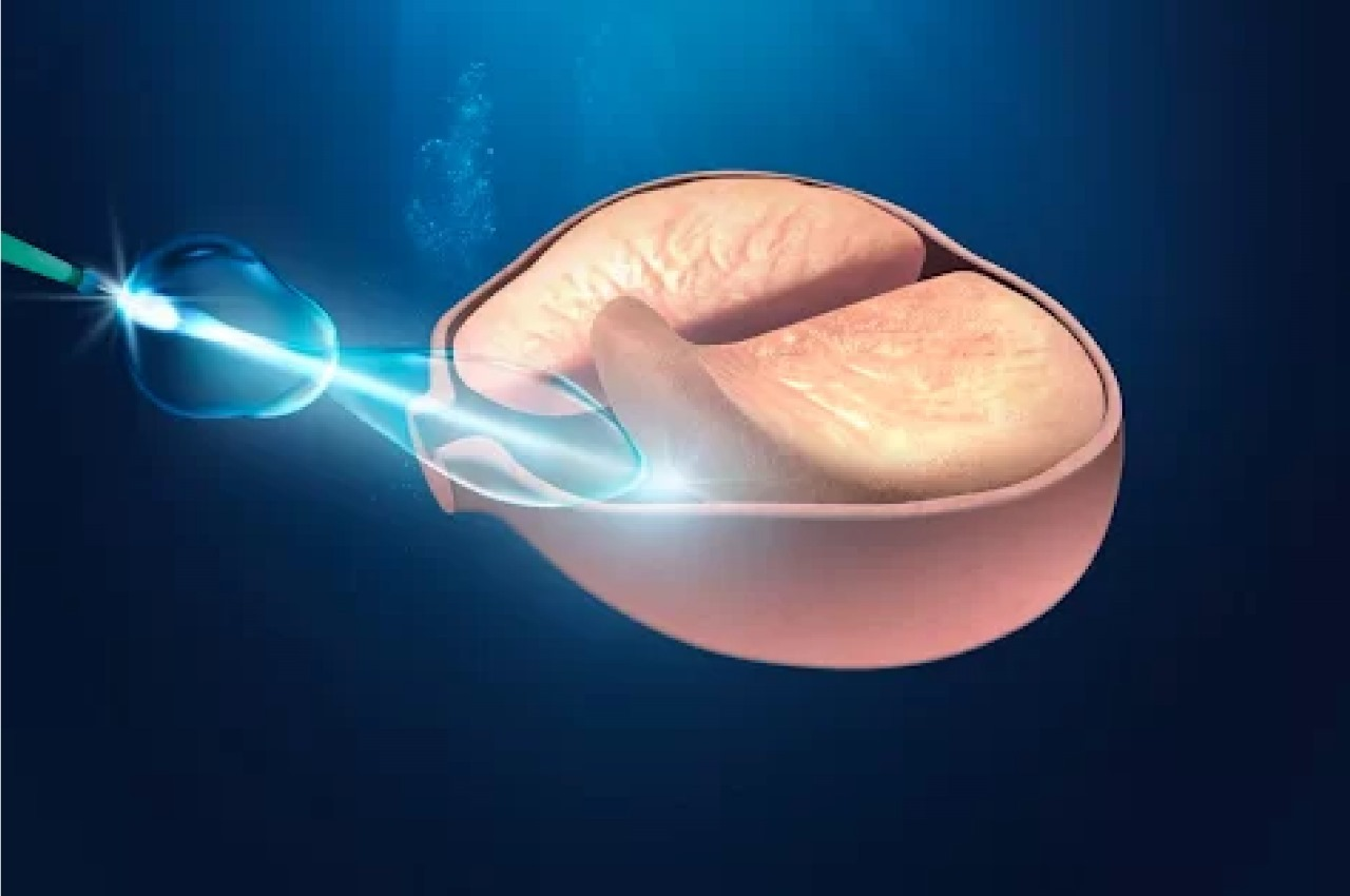 HoLEP – ENUCLEAÇÃO DA
PRÓSTATA COM LASER