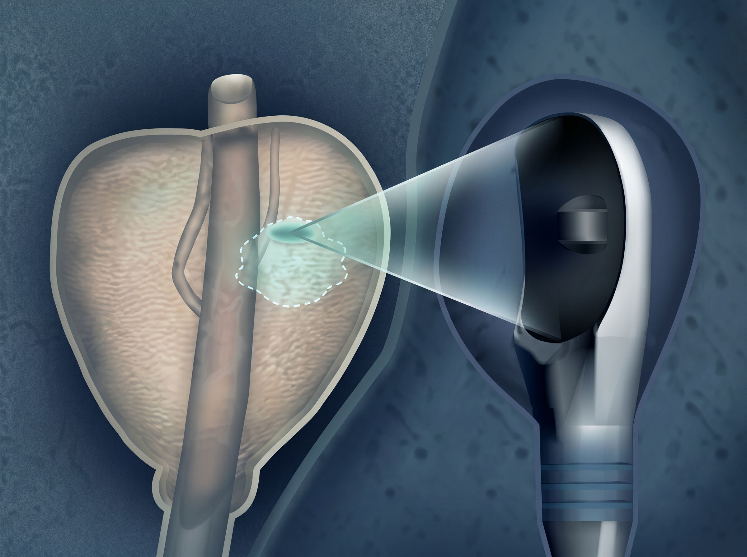 TERAPIA FOCAL
PARA TUMORES